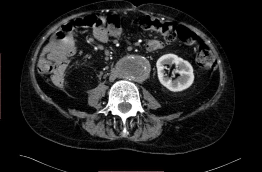 Abdominal aortic interposition tube graft and aneurysm thrombosis (Radiopaedia 71438-81857 Axial C+ arterial phase 97).jpg