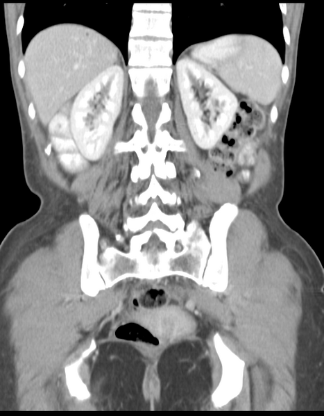 File:Abdominal desmoid tumor (Radiopaedia 41007-43740 Coronal C+ portal venous phase 30).png
