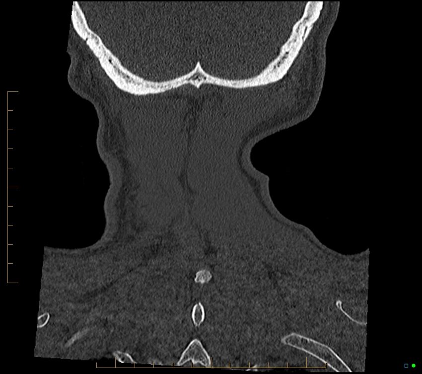 Accessory articulation of cervical transverse processes (Radiopaedia 82715-96933 Coronal non-contrast 109).jpg