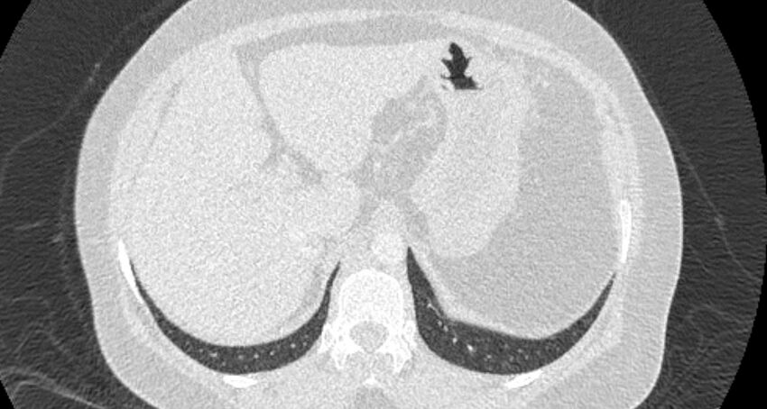 Accessory right inferior hepatic vein (Radiopaedia 65245-74259 Axial lung window 73).jpg