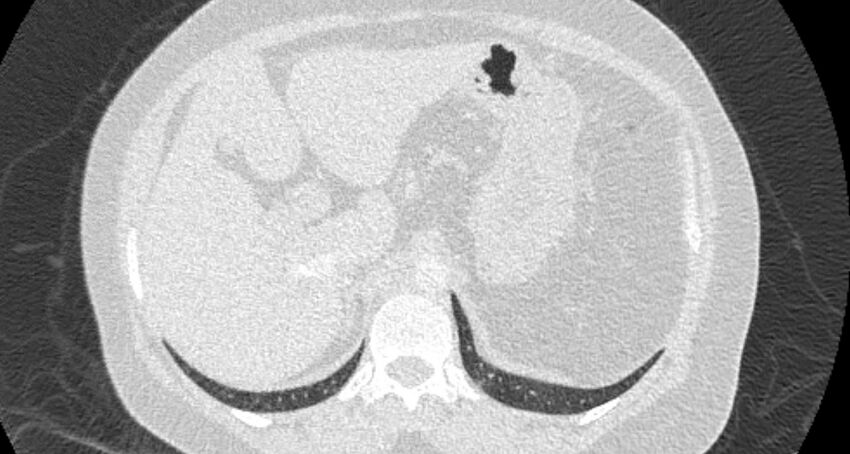 Accessory right inferior hepatic vein (Radiopaedia 65245-74259 Axial lung window 75).jpg
