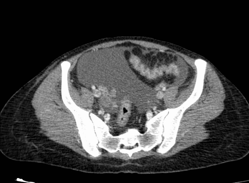 File:Acute Budd-Chiari syndrome (Radiopaedia 60858-68638 Axial C+ portal venous phase 239).jpg