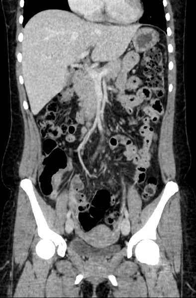 File:Acute appendicitis (Radiopaedia 22892-22918 Coronal C+ portal venous phase 20).png
