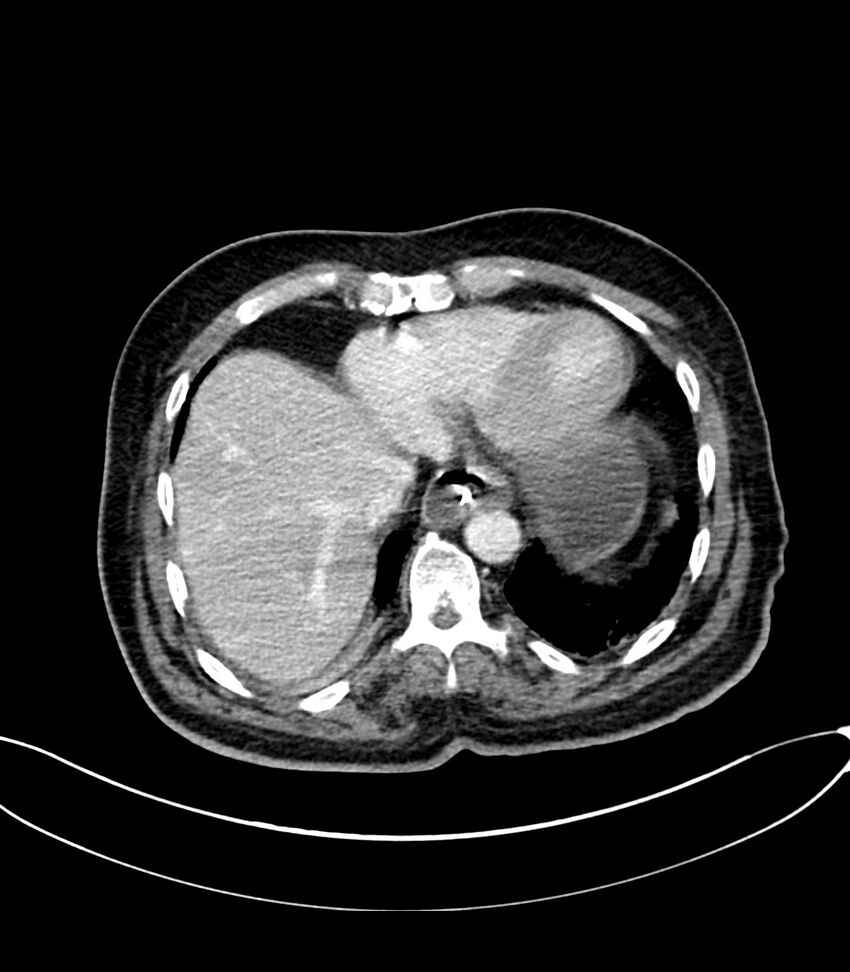 Acute arterial mesenteric ischemia (Radiopaedia 78238-90828 Axial C+ portal venous phase 20).jpg