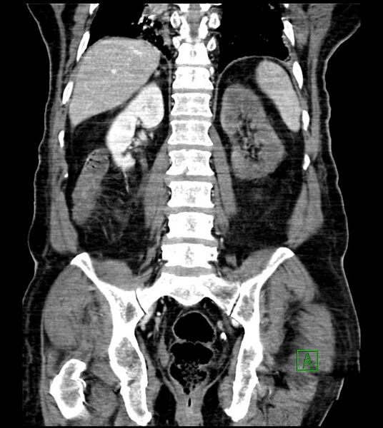 File:Acute arterial mesenteric ischemia (Radiopaedia 78238-90828 Coronal C+ portal venous phase 65).jpg
