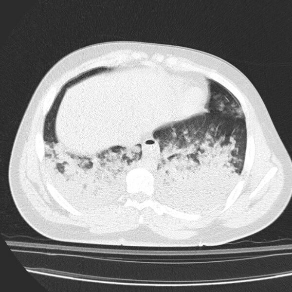 File:Acute aspiration pneumonitis (Radiopaedia 33605-34703 Axial lung window 72).jpg