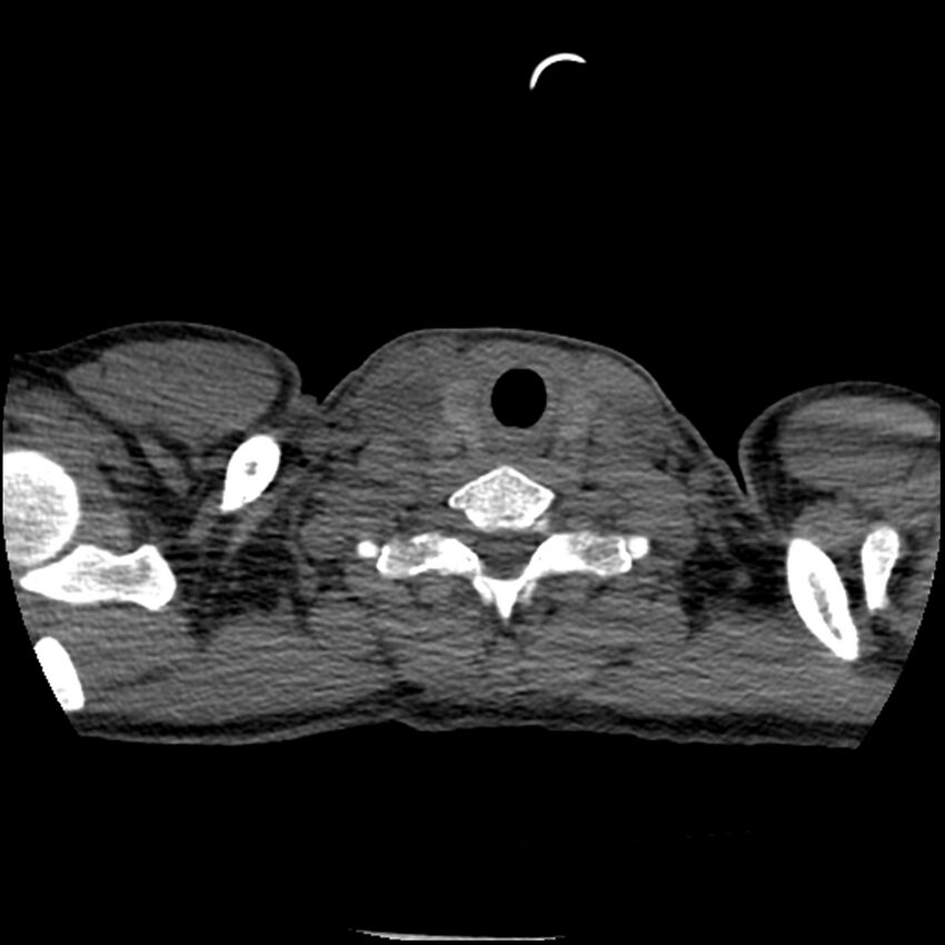 Acute chest syndrome - sickle cell disease (Radiopaedia 42375-45499 Axial C+ CTPA 3).jpg