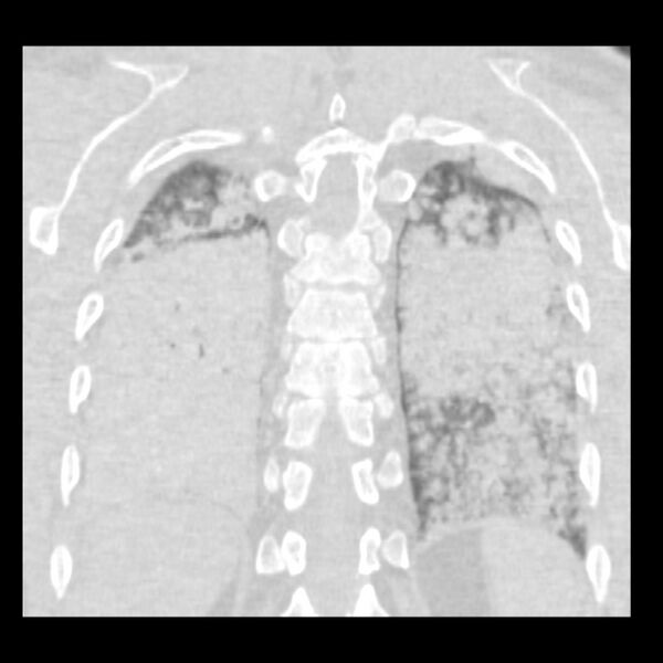 File:Acute diffuse alveolar hemorrhage (Radiopaedia 41323-44158 Coronal lung window 47).jpg