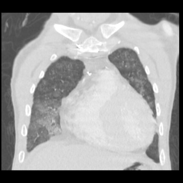File:Acute diffuse alveolar hemorrhage (Radiopaedia 41323-44158 Coronal lung window 8).jpg