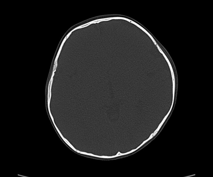 File:Acute hemorrhagic contusion (Radiopaedia 63660-72336 Axial bone window 33).jpg