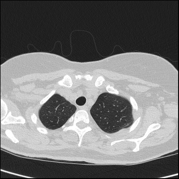 File:Acute interstitial pneumonitis (Radiopaedia 45404-49453 Axial lung window 13).jpg