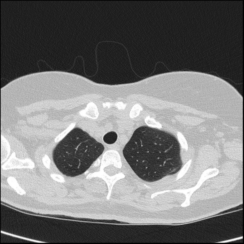 Acute interstitial pneumonitis (Radiopaedia 45404-49453 Axial lung window 13).jpg