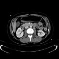 Acute myocardial infarction in CT (Radiopaedia 39947-42415 Axial C+ portal venous phase 54).jpg