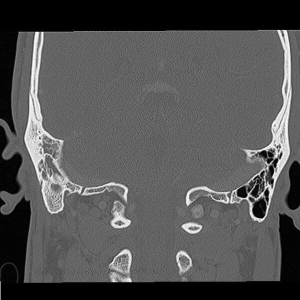 File:Acute otomastoiditis (Radiopaedia 28329-28575 Coronal bone window 3).jpg