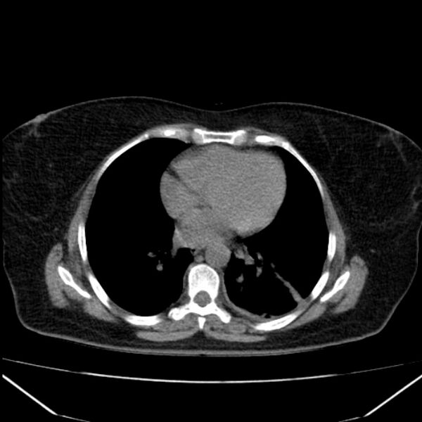 File:Acute pancreatitis - Balthazar C (Radiopaedia 26569-26714 Axial non-contrast 7).jpg