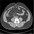 Acute pancreatitis - mild (Radiopaedia 27796-28033 Axial non-contrast 37).jpg