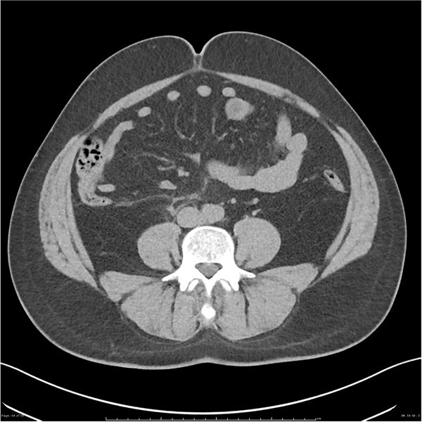 File:Acute pancreatitis - mild (Radiopaedia 27796-28033 Axial non-contrast 37).jpg