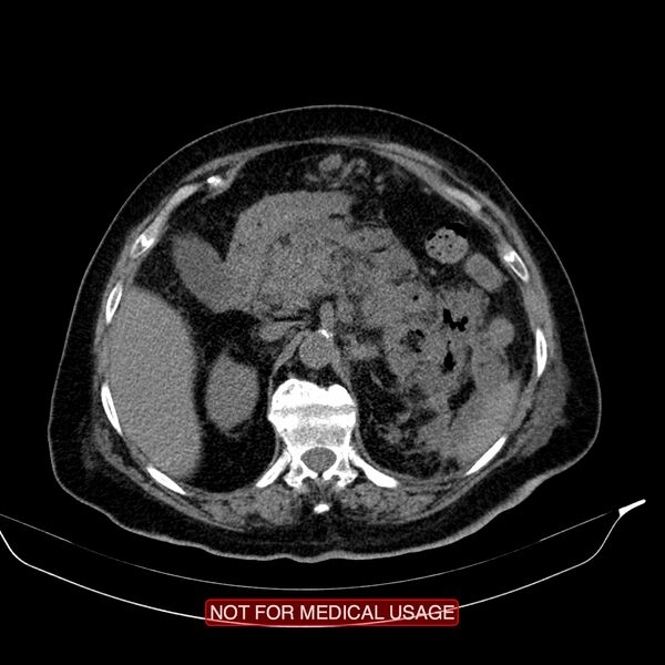 File:Acute pancreatitis with infected necrosis (Radiopaedia 26454-26585 Axial non-contrast 10).jpg
