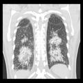 Acute pulmonary edema on CT (Radiopaedia 33582-34672 Coronal lung window 30).jpg