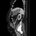 Acute pyelonephritis (Radiopaedia 25657-25837 Sagittal renal parenchymal phase 59).jpg