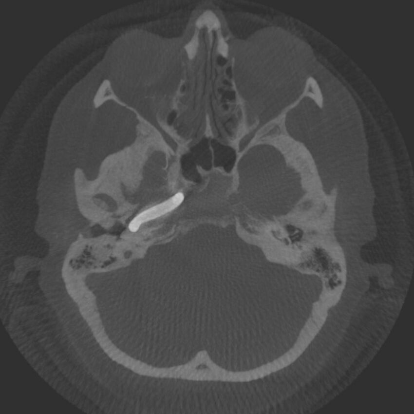 Acute subarachnoid hemorrhage and accessory anterior cerebral artery (Radiopaedia 69231-79010 Axial arterial - MIP 15).jpg