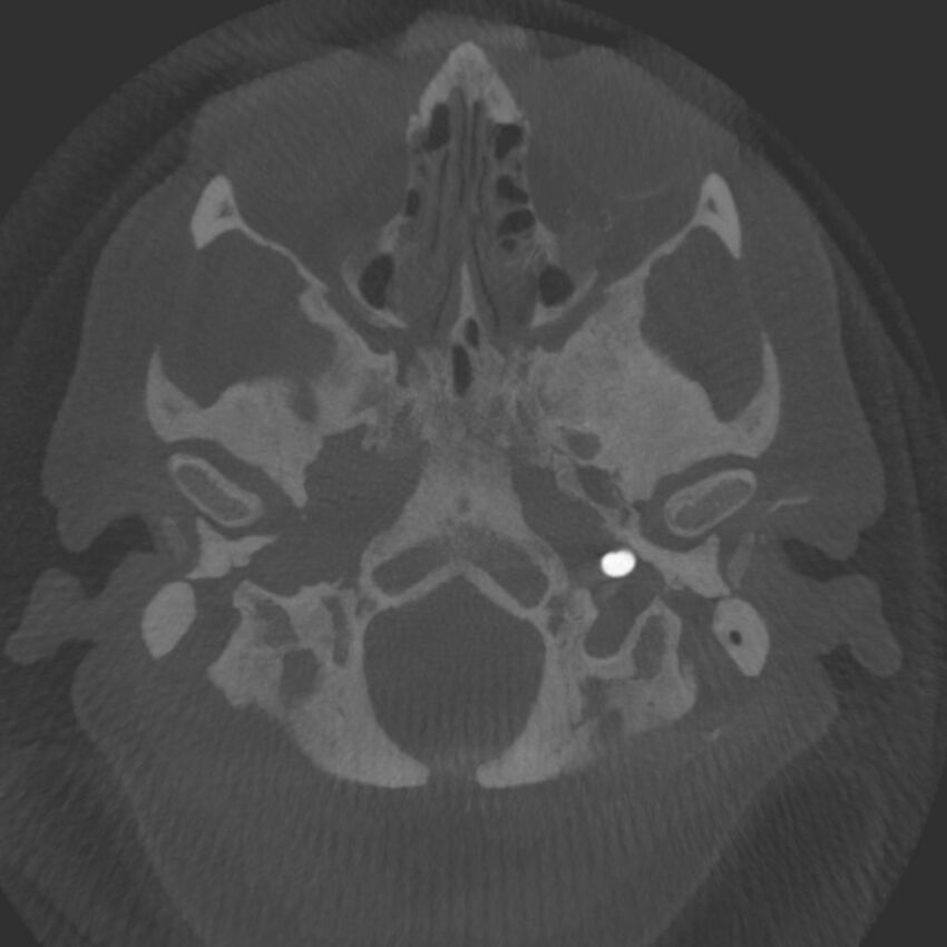 Acute subarachnoid hemorrhage and accessory anterior cerebral artery (Radiopaedia 69231-79010 C 4).jpg