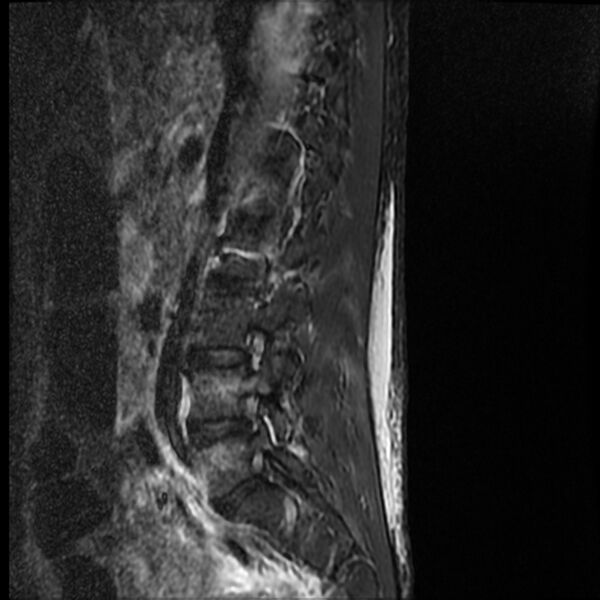 File:Acute vertebral body compression fractures (Radiopaedia 31757-32694 Sagittal STIR 13).jpg