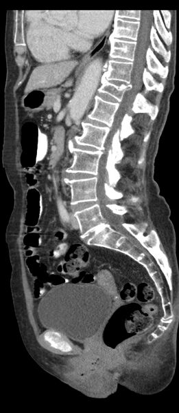 File:Adenocarcinoma of cecum (Radiopaedia 59222-66549 Sagittal C+ portal venous phase 43).jpg