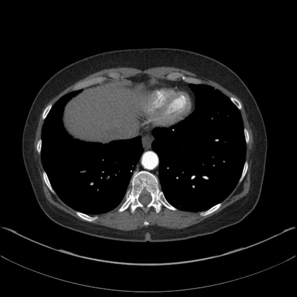 File:Adenocarcinoma of the lung (Radiopaedia 44205-47803 Axial C+ portal venous phase 67).jpg