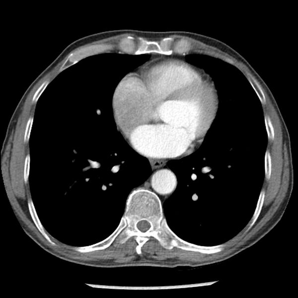 File:Adenocarcinoma of the lung - micropapillary predominant (Radiopaedia 42446-45563 Axial C+ portal venous phase 48).jpg