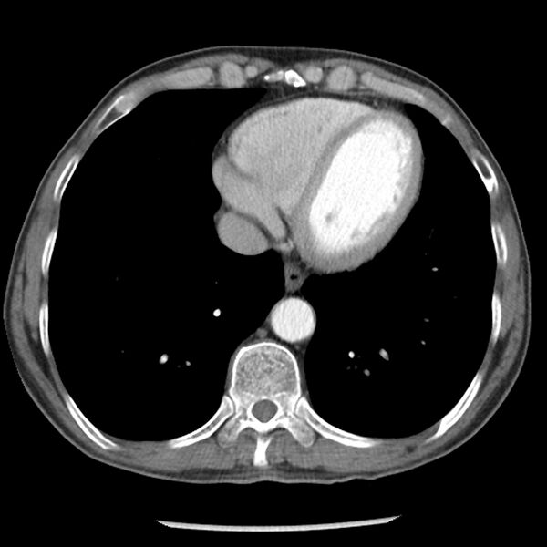 File:Adenocarcinoma of the lung - micropapillary predominant (Radiopaedia 42446-45563 Axial C+ portal venous phase 55).jpg