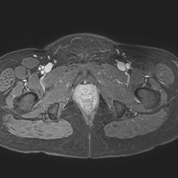 File:Adenomyoma of the uterus (Radiopaedia 9871-10439 Axial T1 C+ fat sat 3).jpg