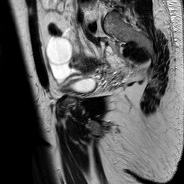 File:Adenomyoma of the uterus (Radiopaedia 9871-10439 Sagittal T2 7).jpg