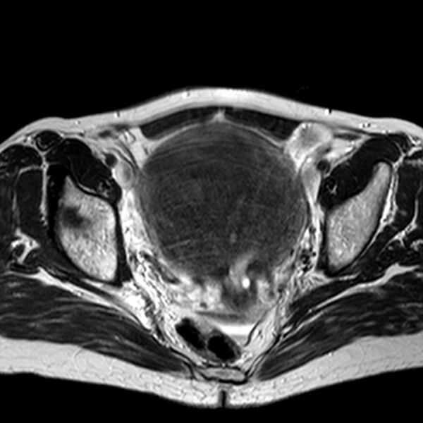 File:Adenomyoma of the uterus (huge) (Radiopaedia 9870-10438 Axial T2 18).jpg