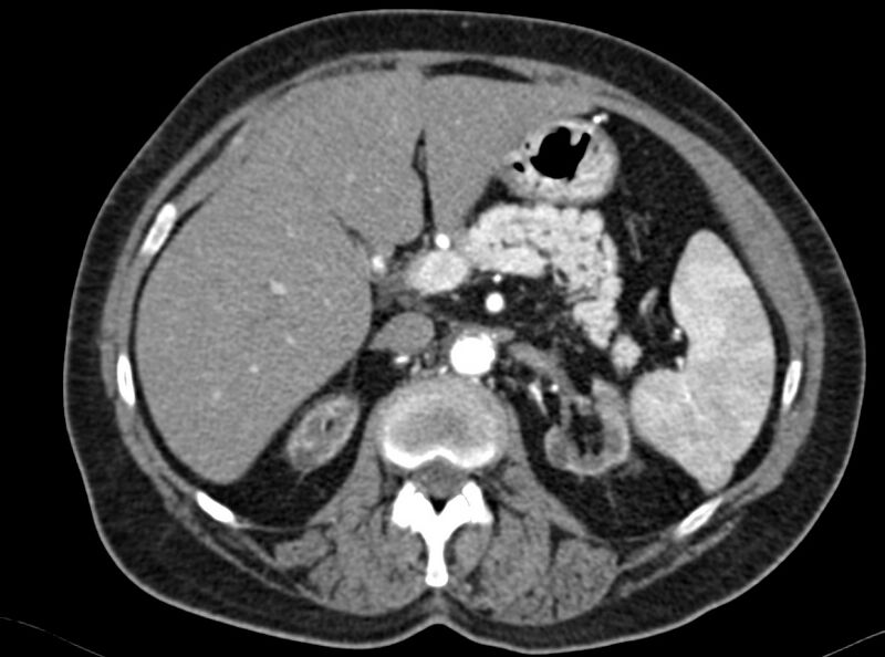 File:Adenomyomatosis of the gallbladder (Radiopaedia 12142-12483 Axial C+ arterial phase 5).jpg