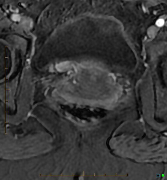 File:Adenomyosis uterus with hematometra (Radiopaedia 45779-50011 Axial T1 C+ fat sat 53).jpg