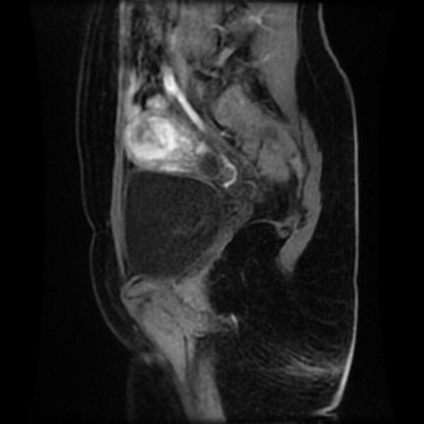 File:Adenomyosis within a septate uterus (Radiopaedia 69963-79981 Sagittal LAVA-Dyn 9).jpg