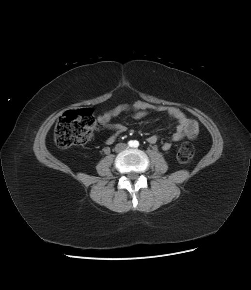 File:Adrenal cortical carcinoma with IVC invasion and thrombosis (Radiopaedia 34307-35597 Axial C+ arterial phase 52).jpg