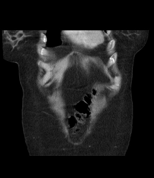 File:Adrenal cortical carcinoma with IVC invasion and thrombosis (Radiopaedia 34307-35597 Coronal C+ portal venous phase 11).jpg