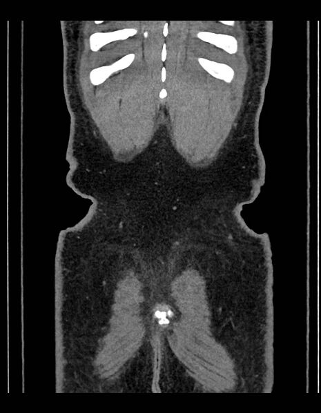 File:Adrenal myelolipoma - bilateral (Radiopaedia 74805-85810 Coronal C+ portal venous phase 48).jpg