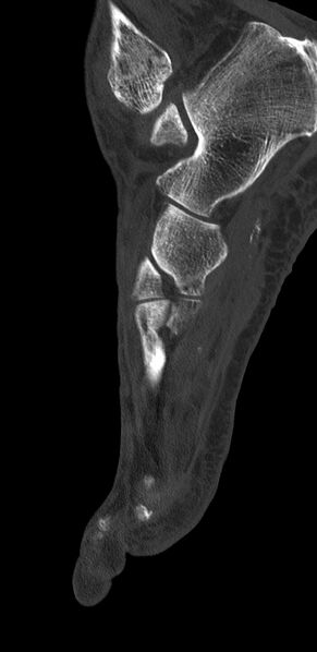 File:Advanced osteomyelitis due to open metatarsal fracture (Radiopaedia 83891-99095 C 15).jpg