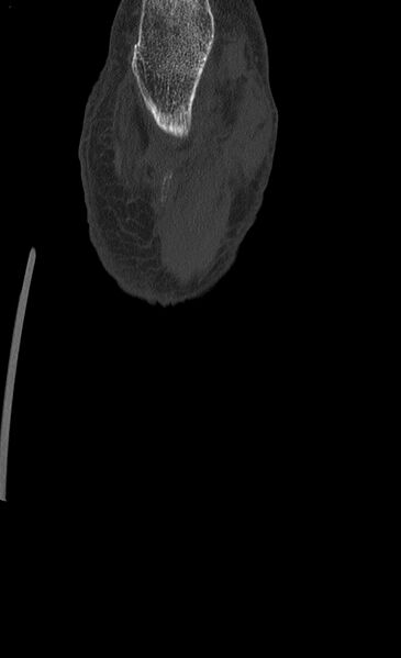 File:Advanced osteomyelitis due to open metatarsal fracture (Radiopaedia 83891-99095 Coronal bone window 19).jpg