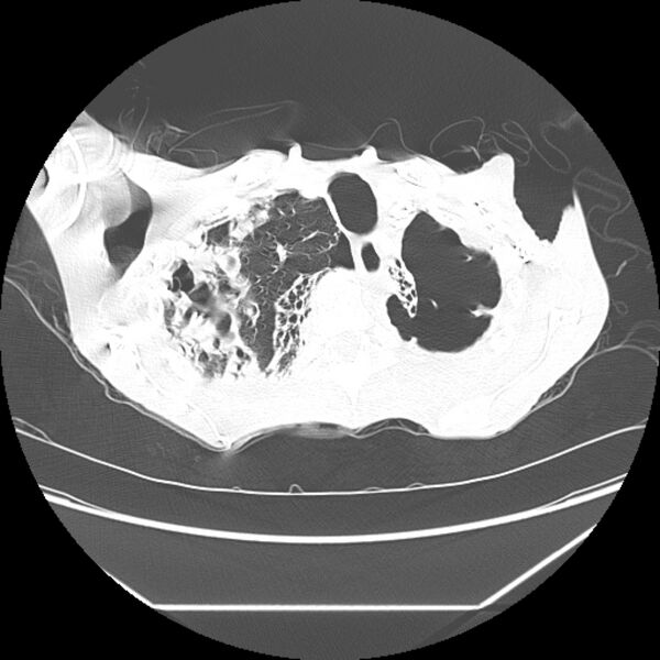 File:Advanced pulmonary tuberculosis (Radiopaedia 8599-9431 Axial lung window 6).jpg