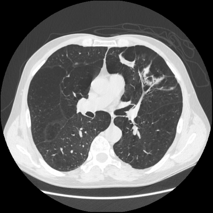 Alpha-1-antitrypsin deficiency (Radiopaedia 40993-43722 Axial lung window 112).jpg