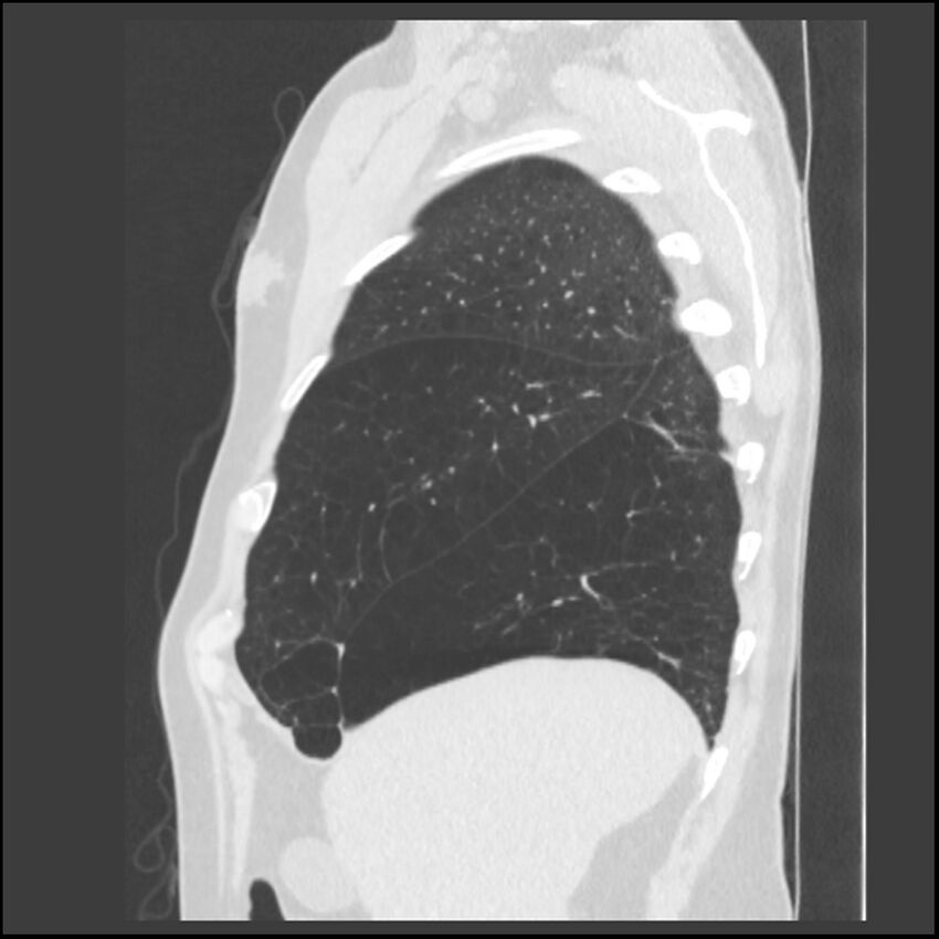 Alpha-1-antitrypsin deficiency (Radiopaedia 40993-43722 Sagittal lung window 226).jpg