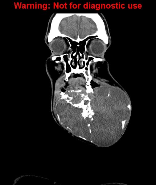 File:Ameloblastoma (Radiopaedia 33126-34164 D 17).jpg