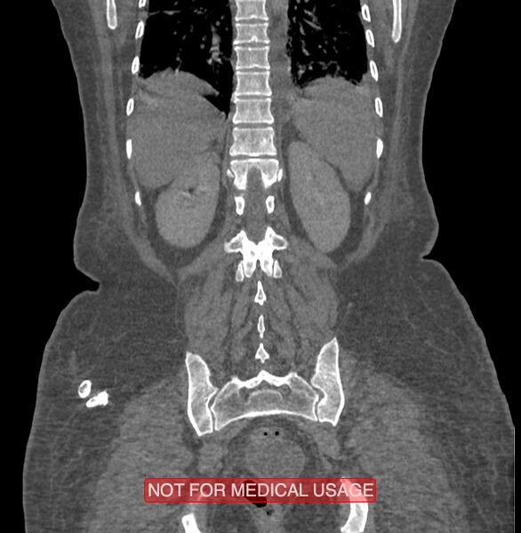 File:Amoebic enterocolitis with liver abscess (Radiopaedia 35100-36609 B 161).jpg