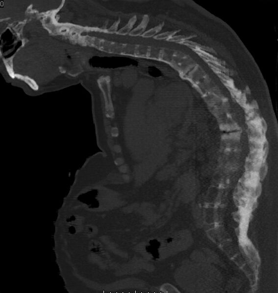 File:Ankylosing spondylitis with pseudoarthrosis (Radiopaedia 17439-17132 Sagittal bone window 1).jpg