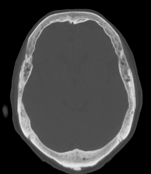 File:Anomalous intracranial venous drainage (Radiopaedia 28161-28418 Axial 16).png