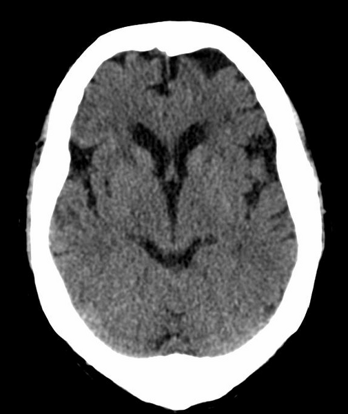 File:Anomalous intracranial venous drainage (Radiopaedia 28161-28418 Axial 27).png